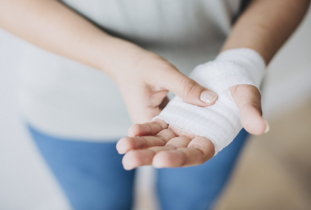 Woman holding a hand wrapped in a gauze bandage, symbolizing personal injury claims and legal support in the West End.